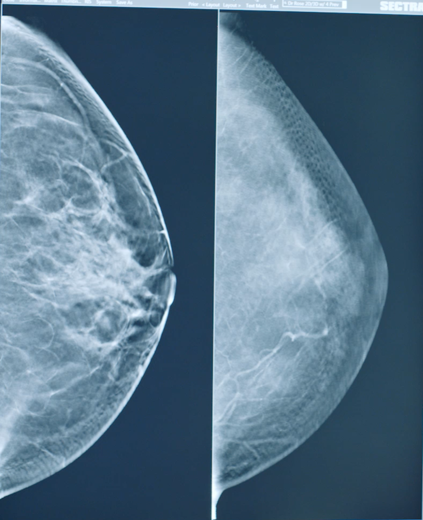 What Does It Mean to Have Dense Breasts? 