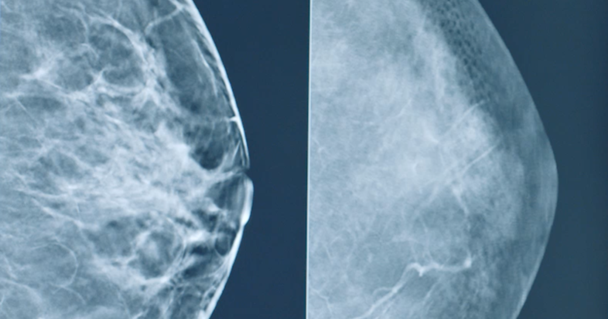 nonproliferative fibrocystic breast changes