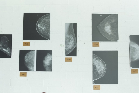 Mammogram Results Examples